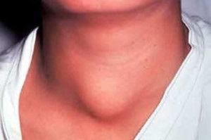 Cartilajul tiroidian al structurii, funcțiilor și problemelor sale