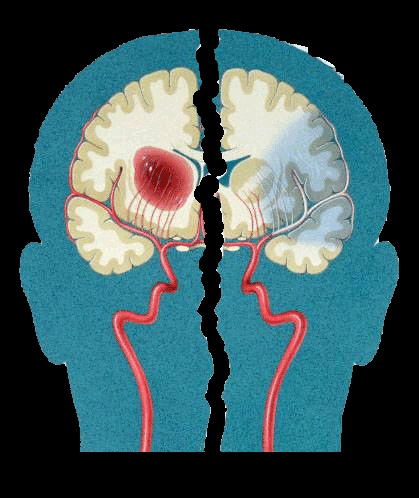 Scalarea abcd2 evaluarea riscului de accident vascular cerebral după atac ischemic tranzitoriu - jurnal de calitate