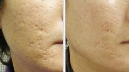 Distrugerea pielii la piele și diferența de dermabraziune - o nouă cosmetologie