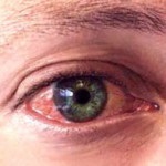 Сльозоточивість очей, причини виникнення, методи лікування