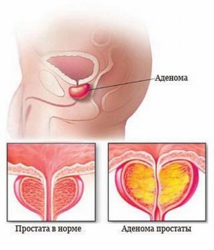 Etapele (grade) ale simptomelor și tratamentului adenomului prostatic