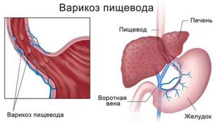 Stenoza și simptomele esofagiene