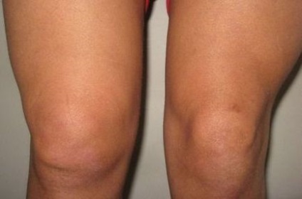 Tendinita genunchiului provoacă simptomele și tratamentul