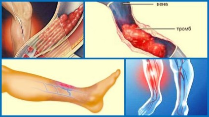 Tromboflebita la extremitățile inferioare, semne, simptome, tratament