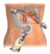 Eliminarea vezicii biliare prin laser chirurgical