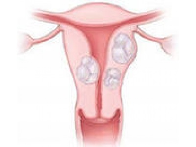 Sterilitatea la un miom de uter Caracteristici ale recepției