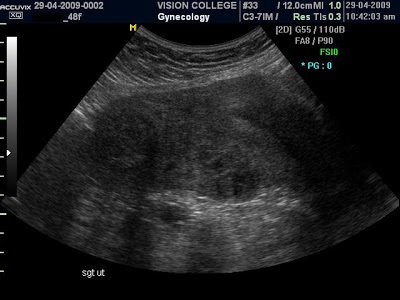 Una miomă a uterului dimensiunea patologiei și modul de determinare a patologiei