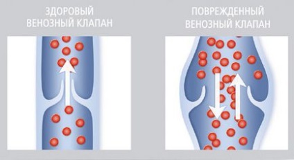 Варикоз лікування народними засобами