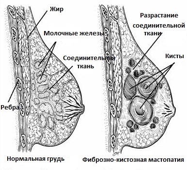 Tipuri de mastopatie a glandelor mamare clasificarea bolilor