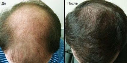 Hajhullás férfiaknál okoz, kezelések és hogyan lehet megállítani alopecia