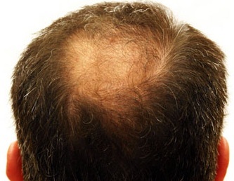 Випадання волосся у чоловіків причини, лікування і як зупинити алопецію