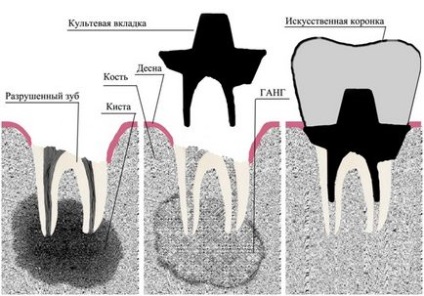 Внутрішньокореневого культевая вкладка - відновлення зубів в стоматологічному центрі «нано-дент»!