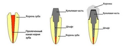 Intracortic insert stump - restaurarea dinților în centrul stomatologic 