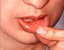 Un mic ulcer sa deschis în gură, cum este să vindecăm
