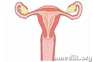 Inflamația organelor genitale feminine - simptome și tratament