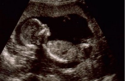 Harm ultrahang korai terhesség