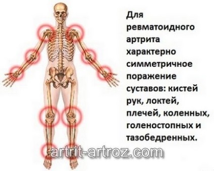 Все про лікування ревматоїдного артриту народними засобами