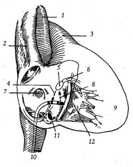 Tratamentul chirurgical al tahicardiei - tratament cardiac