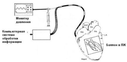 Tratamentul chirurgical al tahicardiilor ventriculare - cardiolog - un loc despre bolile inimii și vaselor de sânge