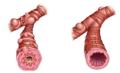 Tratamentul bolii pulmonare obstructive cronice în străinătate