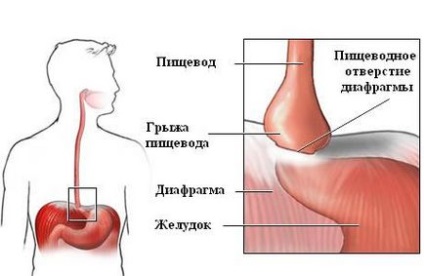 Хронічний дистальний рефлюкс езофагіт особливості лікування