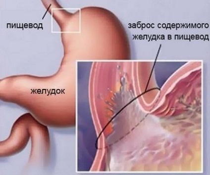 Ezofagita cronică distală la distanță prezintă tratament