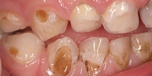 Boli ale dinților copiilor - cauze ale bolilor