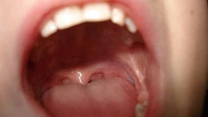Bolile afecțiunilor gurii dinților, gingiilor, ulcerului