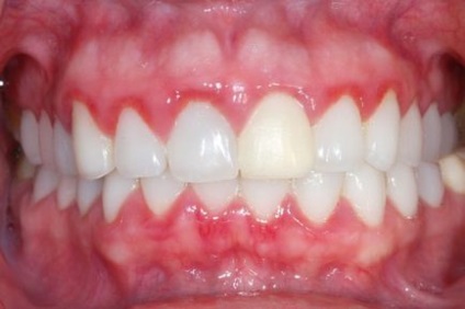 Bolile afecțiunilor gurii dinților, gingiilor, ulcerului
