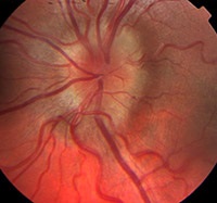 Disfuncțiile discului nervos optic, cauze, simptome și tratament - Enciclopedia medicală