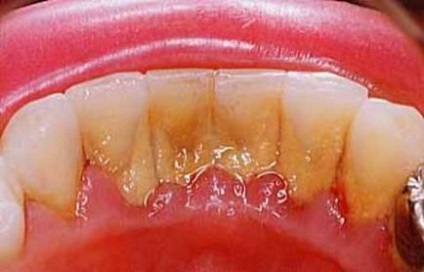 Зуби курця як сигарети впливають на зуби людини, яка палить
