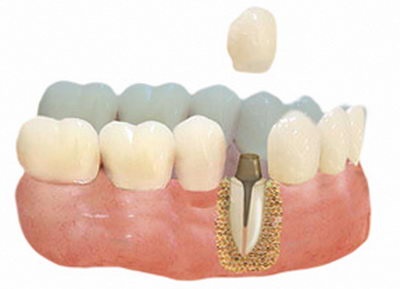 Зубні штифти різновиди, умови установки - про виправлення прикусу і брекети
