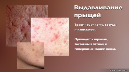 2 Cauzele acneei
