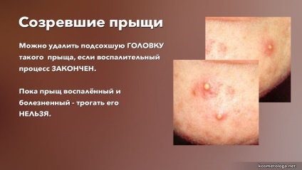 2 Cauzele acneei
