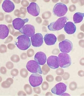 Actinomycosis de iepuri, omedvet