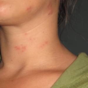 Allergiás a fokhagyma, hagyma, vagy paprika tünetek és hatások