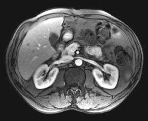 Androsteroma - снимки, видове, причини, симптоми и лечение