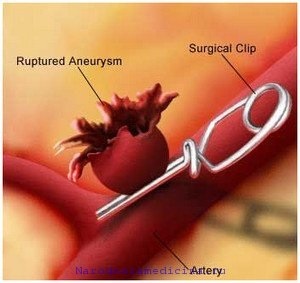 Аневризма судин головного мозку