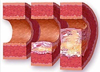 Presiunea arterială și accident vascular cerebral - accident vascular cerebral hipertensiv