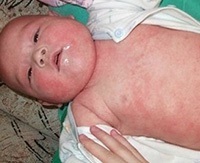 Атопічний дерматит у немовляти симптоми, лікування і дієта для немовляти