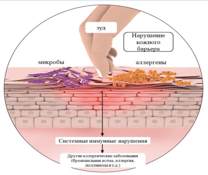 Dermatita atopica la o mama care alapteaza de ce apare la lactatie, simptome, cum se trateaza