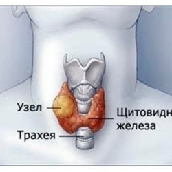 Безсоння при гіпертиреозі щитовидки - скальпель - медичний інформаційно-освітній портал