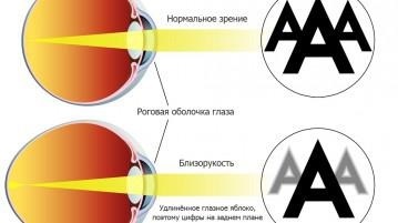 Rövidlátás - egy mínusz vagy plusz, közepes, alacsony fokú myopia szem, halad