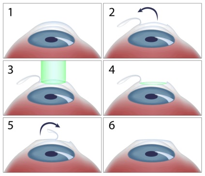 Rövidlátás - egy mínusz vagy plusz, közepes, alacsony fokú myopia szem, halad