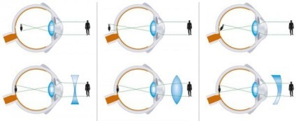 Micopia este o minus sau plus, medie, ușoară, miopie a ochiului, progresivă, cu