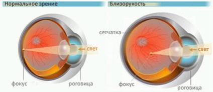 Miopia (miopie) cauzează, simptome, tratament