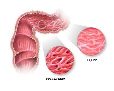 Boala lui Crohn