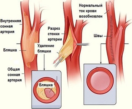 Artera carotidă din stânga doare