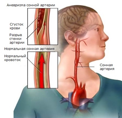 Artera carotidă din stânga doare