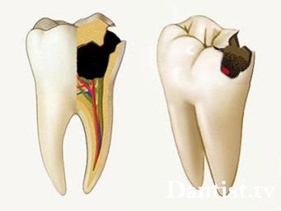 Зъбобол след запълване на каналите, които правят, причини и лечение